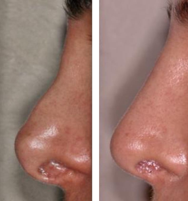 Rinoplastia caso 28 — antes y después